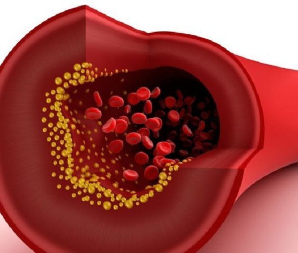 Nanoparticles to treat arteriosclerosis